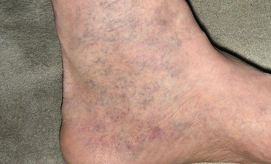 Tips to Avoid Varicose Veins Despite the Nature of Your Job
